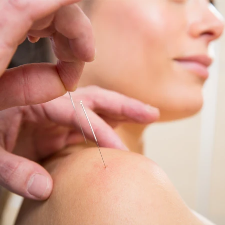 Chiropractic West Monroe LA Woman Receiving Dry Needling Therapy